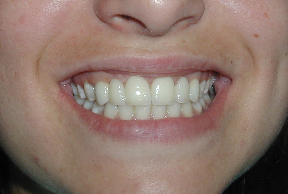 Imagen real coronas de zirconio (circonio) Clínica Dental Moraira