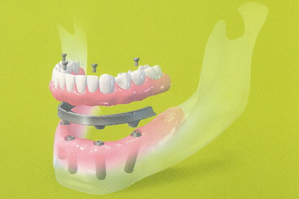 Imagen Implantes dentales de la Clínica Dental Moraira